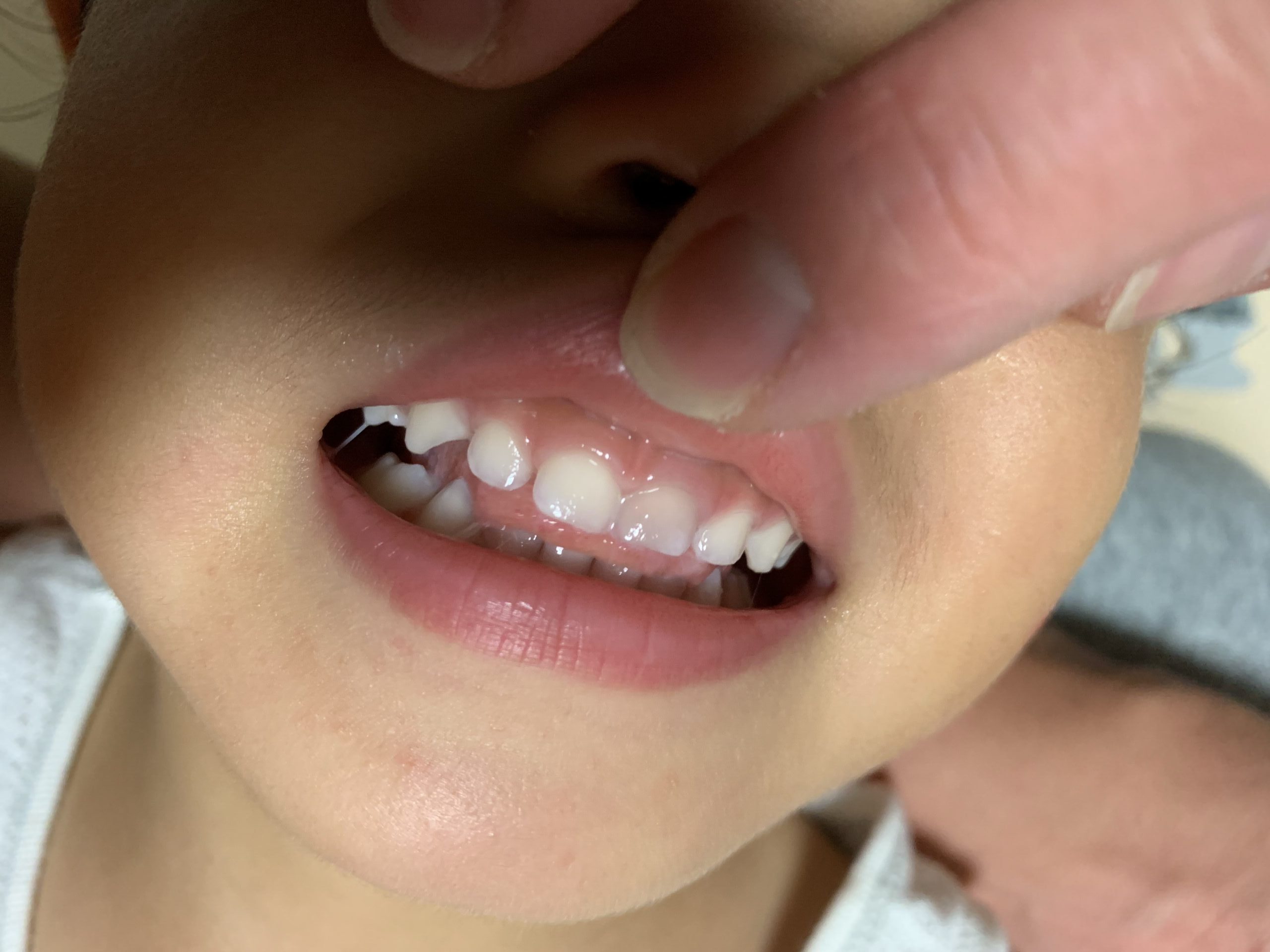 子供 2歳 が歯をぶつけて歯が黒くなったはなし しょうパパ日記